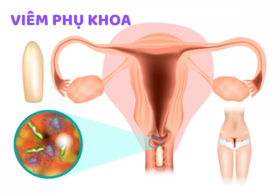 1758524463531898.png VIÊM PHỤ KHOA (1).png